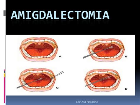 Amigdalectomia