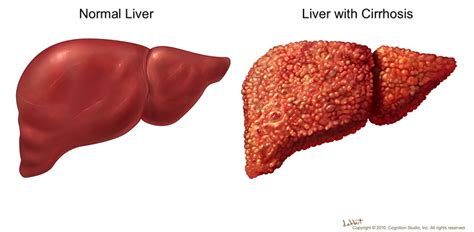 Click2cure What Is Liver Disease Most Common Liver Disease