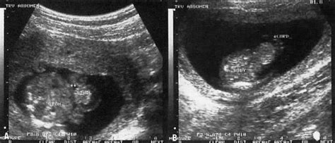 Ultrasound Diagnosis Of Fetal Anomalies Glowm