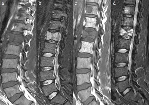 Baseline Spinal Mri A Sagittal T Weighted And B Sagittal Stir Images Download Scientific
