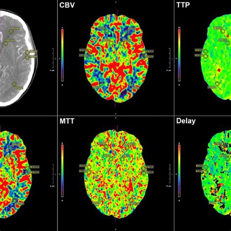 Cbv Cbf And Mtt Whole Brain Surface Ct Perfusion Images Demonstrating