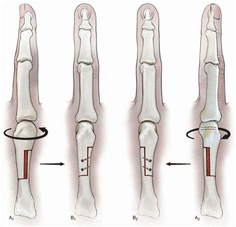 Corrective Osteotomy For Metacarpal And Phalangeal Malunion