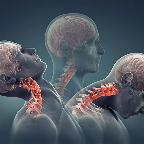 Is Your Neck Posture Causing Headaches Minneapolis Chiropractor