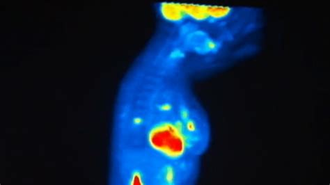 False Positive Mammogram Result May Point To Higher Risk Nbc News