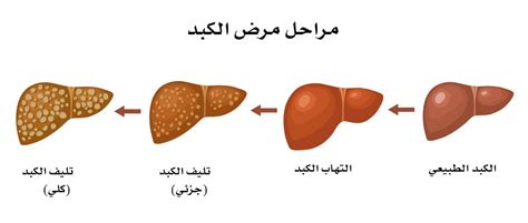 مراحل تليف الكبد F4