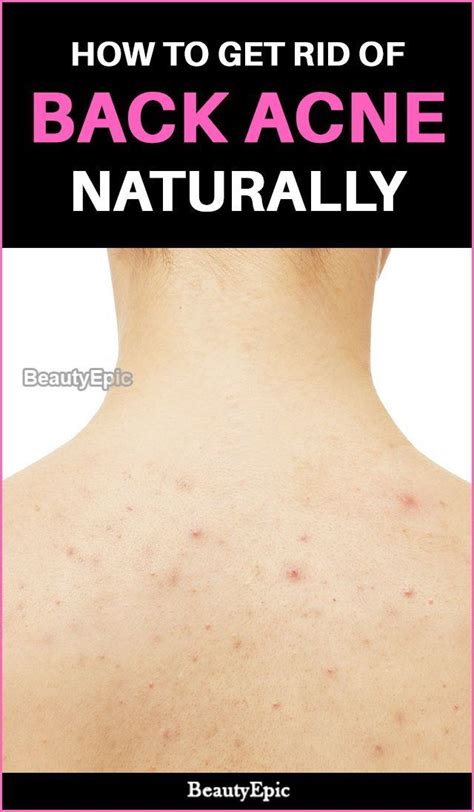 How To Get Rid Of Back Acne Fast Naturally Artofit