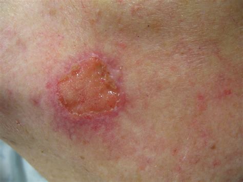 Squamous Cell Carcinoma Of The Skin