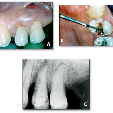Abscess Due To A Root Fracture A Buccal And B Occlusal View C