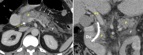 Acute Pancreatitis Post Ercp Radiology At St Vincents University