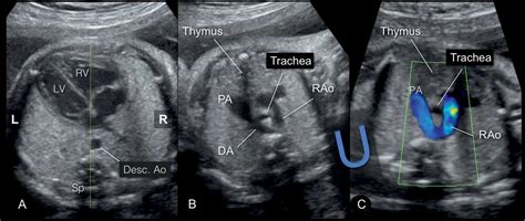 Right Aortic Arch Double Aortic Arch And Aberrant Subclavian Artery Obgyn Key Subclavian