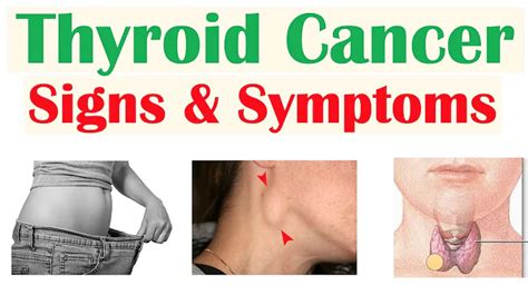 Thyroid Cancer Signs And Symptoms And Why They Occur Shows Lujuba