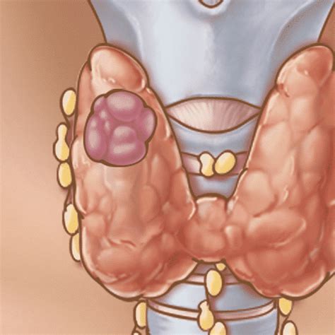 The type you have depends on the type of cell the cancer started in. Well-Differentiated Thyroid Cancer | THANC Guide