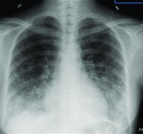 Chest X Ray Posteroanterior View Widespread Consolidation With