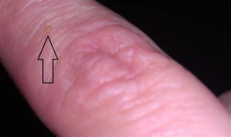 Bed Bug Bite On Finger