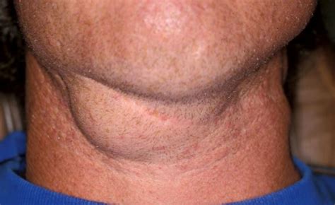 Lump Under Chin Bone Near Throat Neck Cancer Cold Sore Right Or