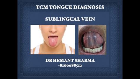 21 April Traditional Acupuncture Tcm Tongue Diagnosis By Sublingual