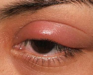 Swollen Eyelids IrisTech