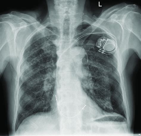 Chest Radiograph Showing Left Sided Iatrogenic Pneumothorax That