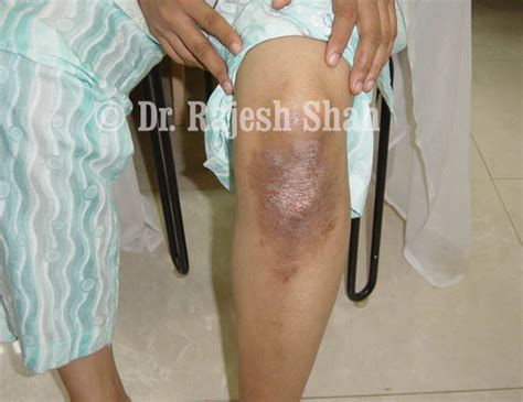 Psoriasis Homeopathy Treatment Causes Factors And Symptoms