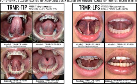 assessment of posterior tongue mobility using lingual‐palatal suction progress towards a