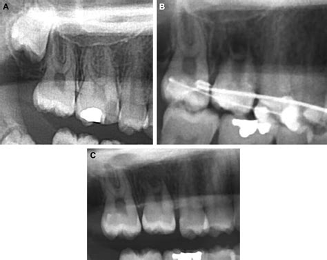 Autotransplantation Of Third Molars With Platelet Rich Plasma For
