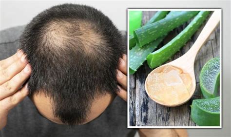 Hair Loss Treatment Nutrient Rich Aloe Vera May Promote Hair Growth