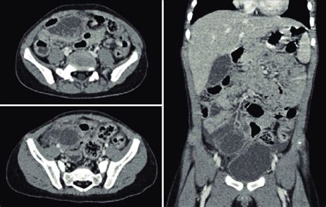 Abdominal Computed Tomography Findings Download Scientific Diagram