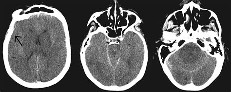 Cureus Pseudohypoxic Brain Swelling After Elective Lumbar Spinal