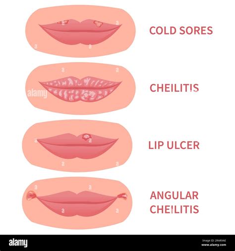 Mundkrankheiten Medizinisches Set Lippenherpes Und Cheilitis Angularis