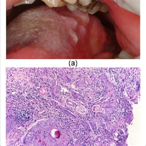 Pdf Two Unusual Cases Of Oral Lichen Planus Arising After Oral Squamous Cell Carcinoma Can