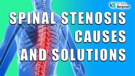 Spinal Stenosis Causes And Solutions 2020 Youtube Spinal Stenosis
