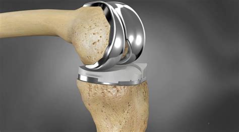 3d Printing Knee Joint