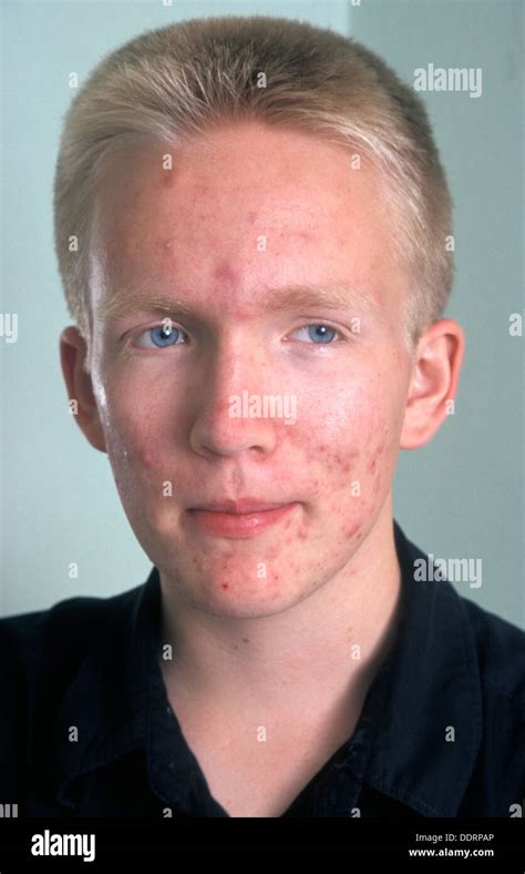 Teenage Boy With Acne Stock Photo Alamy