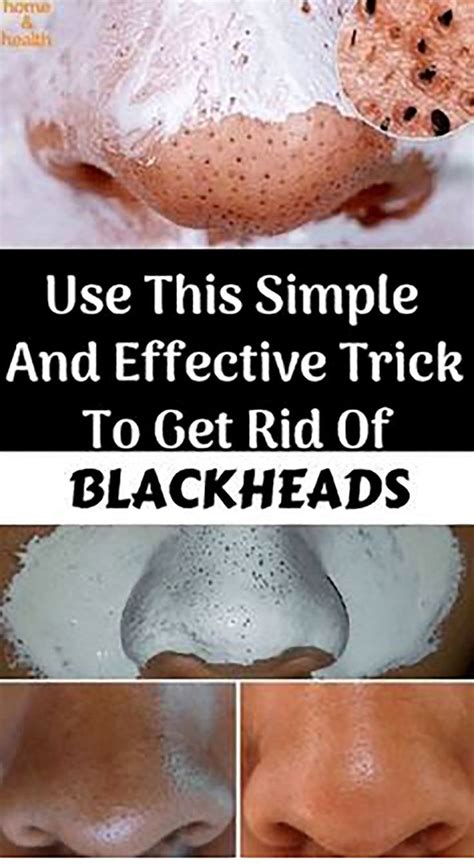 Simple And Effective Trick To Get Rid Of Blackheads Wellness Magazine