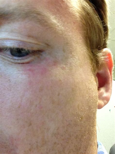 I Have A Small Eczema Ish Looking Rash Below My Left Eye Not