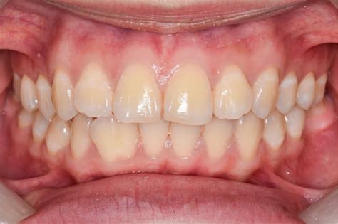 What Are The Symptoms Of Oral Cancer On The Gums?