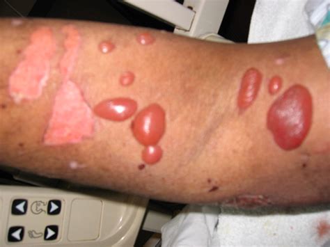 What Is Bullous Pemphigoid Bullous Disease Pigmentation Disorders