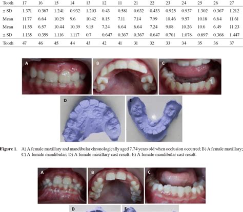Permanent Tooth Eruption Sequence In The Female Subjects Based On