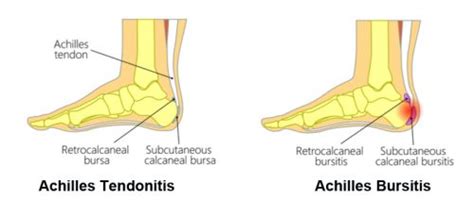 Achilles Bursitis Symptoms Causes Treatment By Ankle Braces