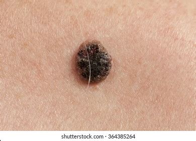 Pixel experience for mi 3 and mi4 cancro /* * your warranty is now void. Squamous Cell Carcinoma Images, Stock Photos & Vectors | Shutterstock