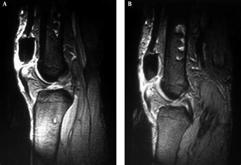 Magnetic Resonance Imaging Mri Of A Right And B Left Knee