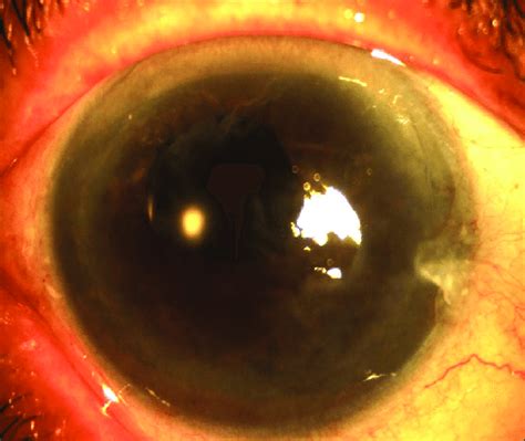 Pseudophakic Bullous Keratopathy Occurred 2 Years After Cataract