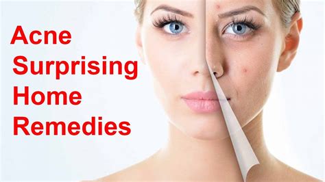 Easy Home Remedies For Acne Surprising Home Remedies For Acne Youtube