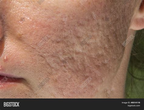 Pimple Acne Scars Image And Photo Free Trial Bigstock