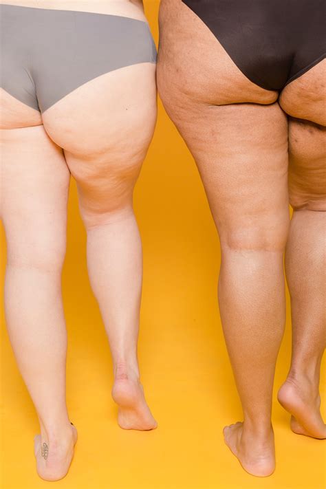 10 amazing tips to get the best cellulite treatment for your legs and thighs — slim n beauty