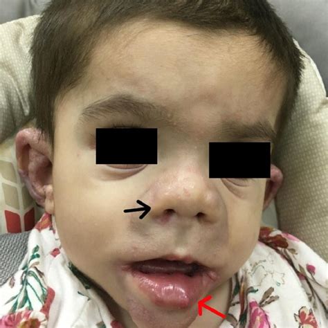 Saddle Nose Deformity With Bilateral Nodules Around The Nasal Alae