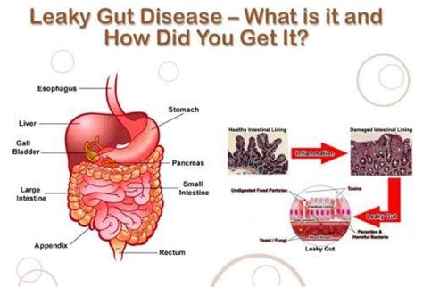 Leaky Gut Syndrome What It Looks Like And What To Do About It Leaky