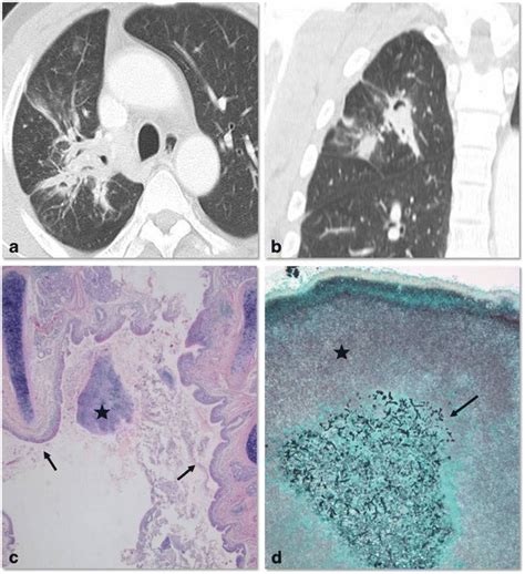 Co Infection Of Bronchiectatic Actinomycosis With Aspergillus In A