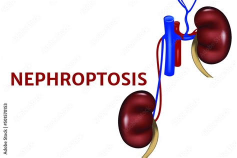 Nephroptosis Anatomical Poster With A Drooping Kidney Vector
