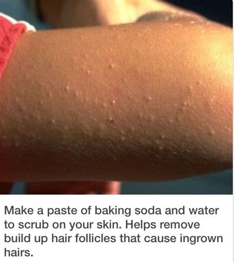 Get Rid Of Those Bumps On Your Arms And Legs Healthy Skin Care